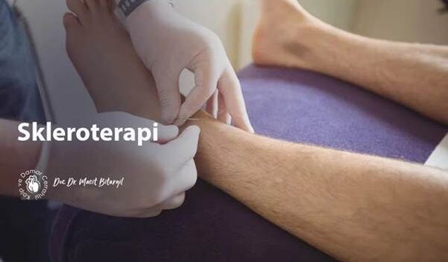 Toplardamar Patolojilerinde Mikro-Girişimsel Yaklaşım: Skleroterapi